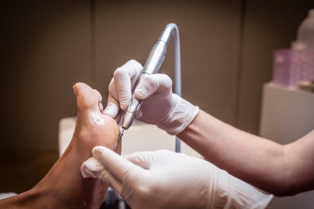 Corns treatment Houston